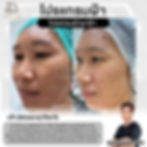 ฉีดสลายฝ้า-ลดาคลินิก-หมอฉัตร