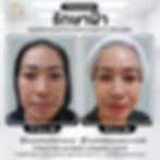 ฉีดเมโสฝ้า-รักษาฝ้า-ลดาคลินิกโคราช