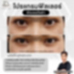 รีวิวฉีดฟิลเลอร์ใต้ตา-ลดาคลินิกโคราช