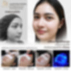 กดสิว-ฉีดสิว-ลดาคลินิก-หมอฉัตร