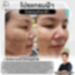 รักษาฝ้าฝังลึก-เมโสฝ้า-หมอฉัตรโคราช