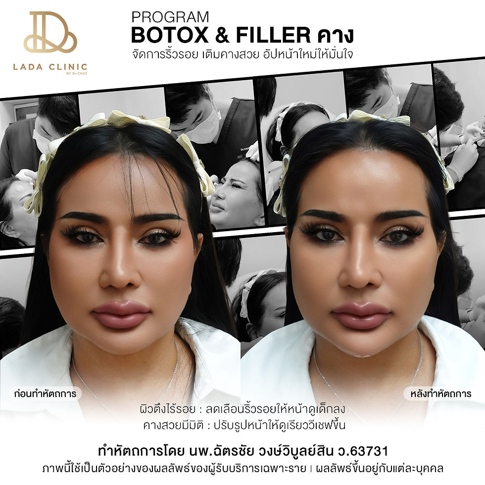 korean-style-chin-filler-korat