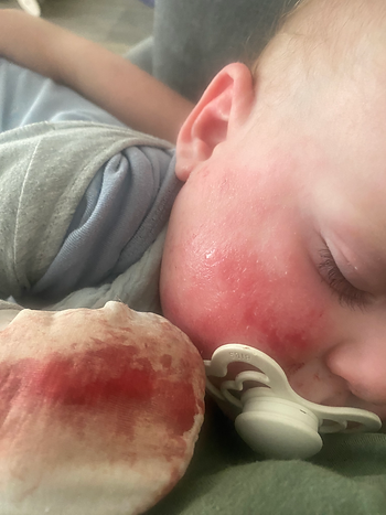 baby with eczema
