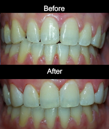 Cosmetic bonding