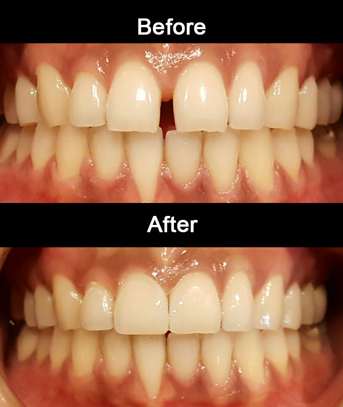 Diastema Closure by Anaheim Dental
