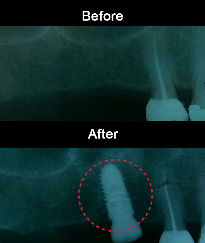 Sinus Lift & Implant