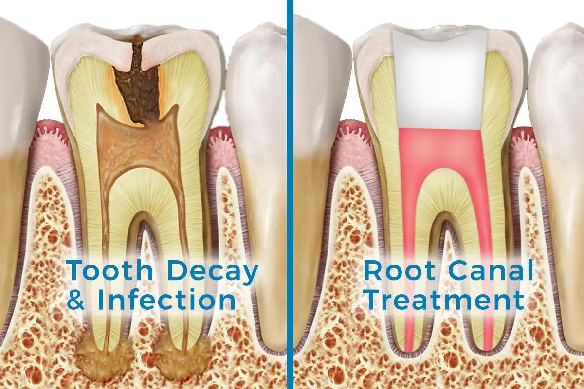 root-canal-dentist-maple-ridge.jpg.webp