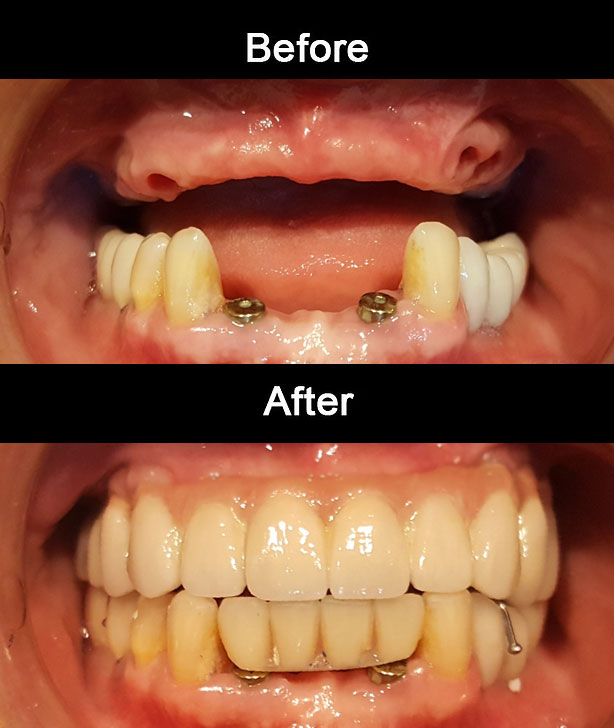 Full mouth implant restoration