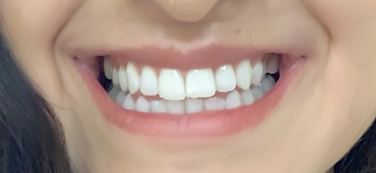 Picture of woman's teeth, radiantly white