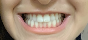 Picture of a womans teeth, slightly yellowed