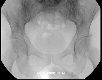 Hip Dysplasia X-Ray