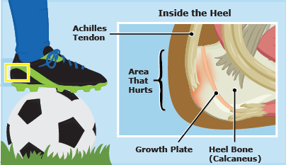 Sever's Disease Physical activity