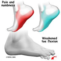 Symptoms of Tarsal Tunnel Syndrome