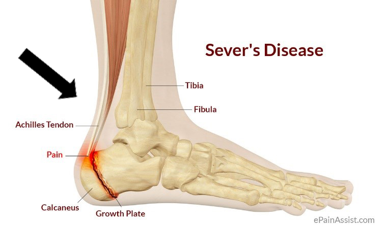 Causes of Sever’s Disease