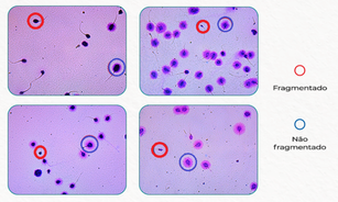 A Importância da Avaliação da Fragmentação do DNA Espermático na Infertilidade Masculina