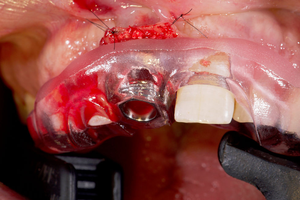 Image courtesy of: dr. Luigi Canullo