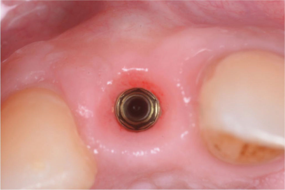 Rehabilitation of a periodontally compromised lateral incisor with large vestibular bone defect