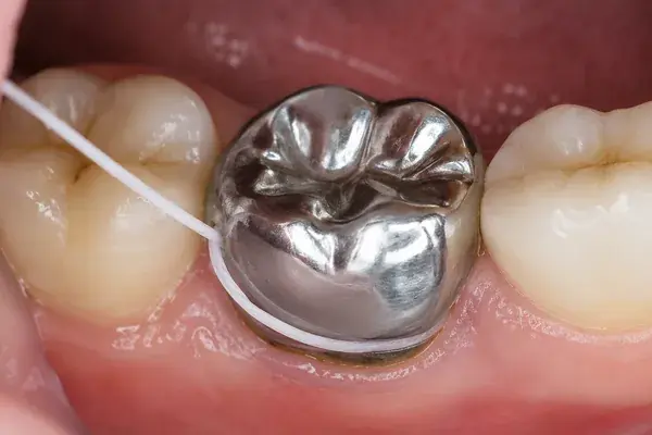C-shape flossing technique around a child's stainless steel crown