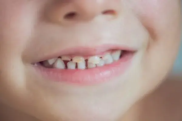 Child with damaged teeth needing dental crowns