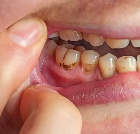 2. Visible plaque on a child’s teeth.webp