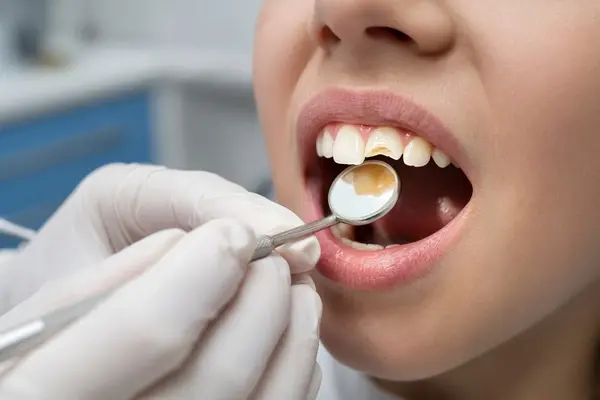 Close-up comparison of enamel, dentin, and pulp levels in a chipped child tooth