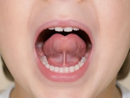 Child's mouth showing tight tongue tie frenulum