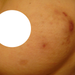 large mark is from direct moxibustion(once), two small holes are from core needle biopsy(once)