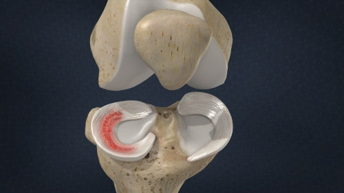 Fixing A Torn Meniscus