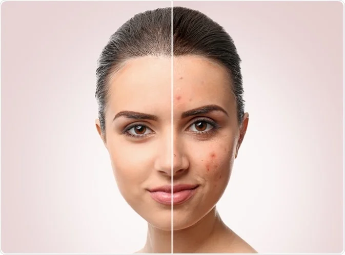 Acne.webp
