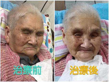 花灑。治療個案分享84 外婆你要好番呀
