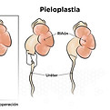pieloplastia.jpg