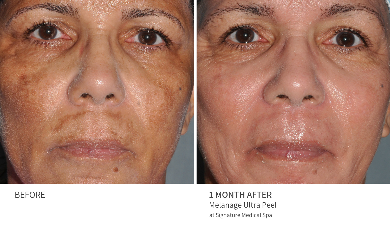 melanage peel near me