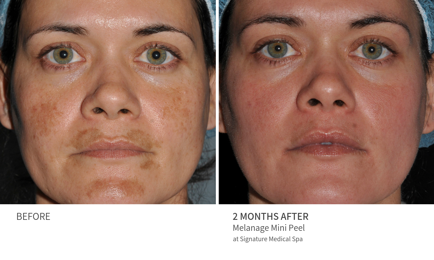 side effects of yellow peel side effects of yellow peel