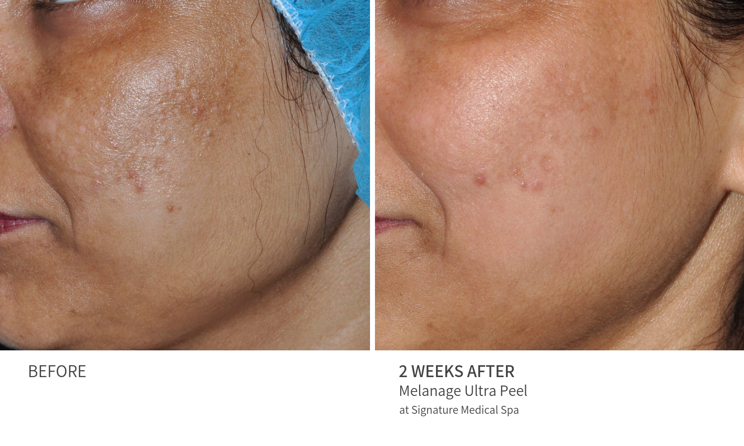 Advanced Peels Signature Medical Spa