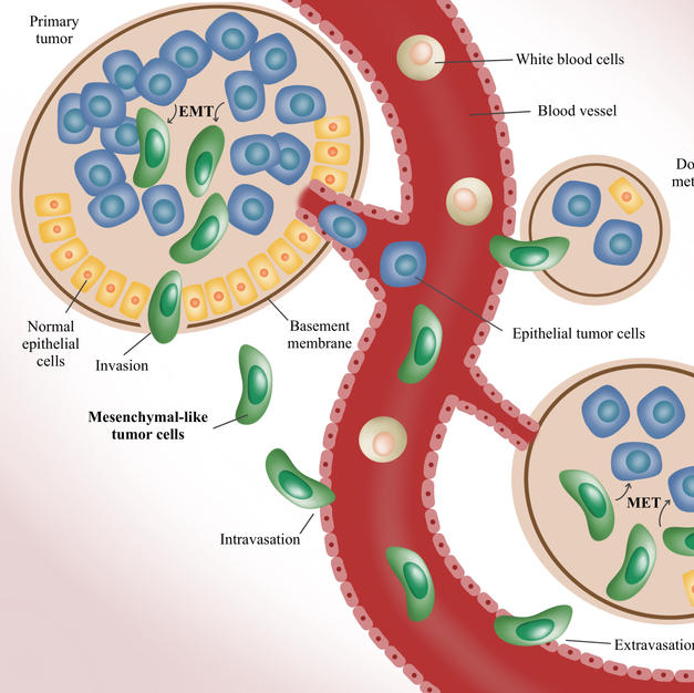 Metastasis of tumor cells
