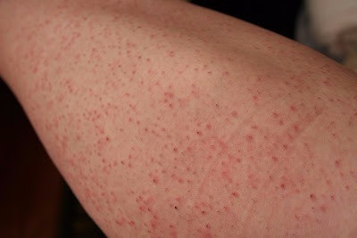 10 Tips To Prevent Ingrown Hair