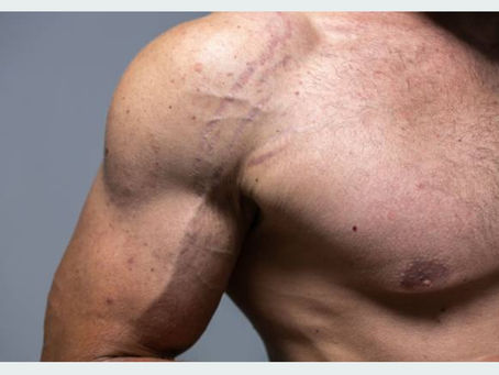 The Magic of Microneedling with Skinpen - Your Ultimate Guide