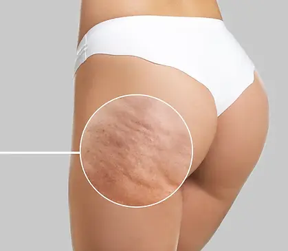 DMV Chill Cellulite Reduction Best Treatment.webp