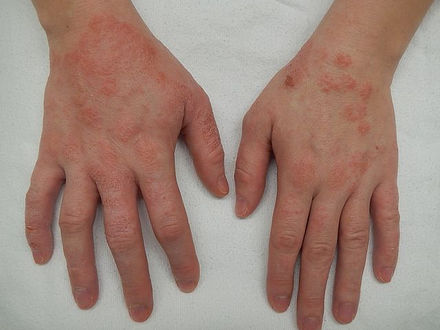 Eczema/AD linked to higher risk of eating disorders