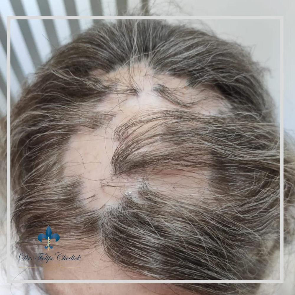 Doenças do couro cabeludo