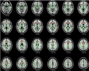 Gray Matters: Too Much Screen Time Damages the Brain
