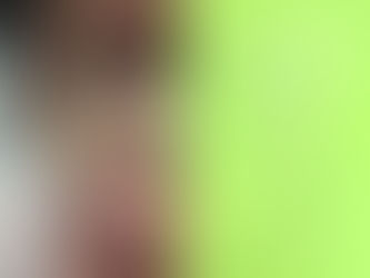 Una Correzione impegnativa: il risultato in sole 3 sedute.