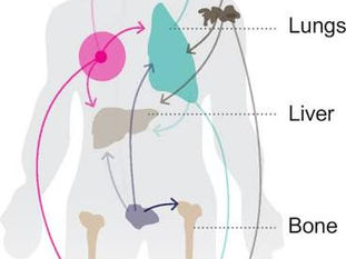 Massage and metastatic cancer