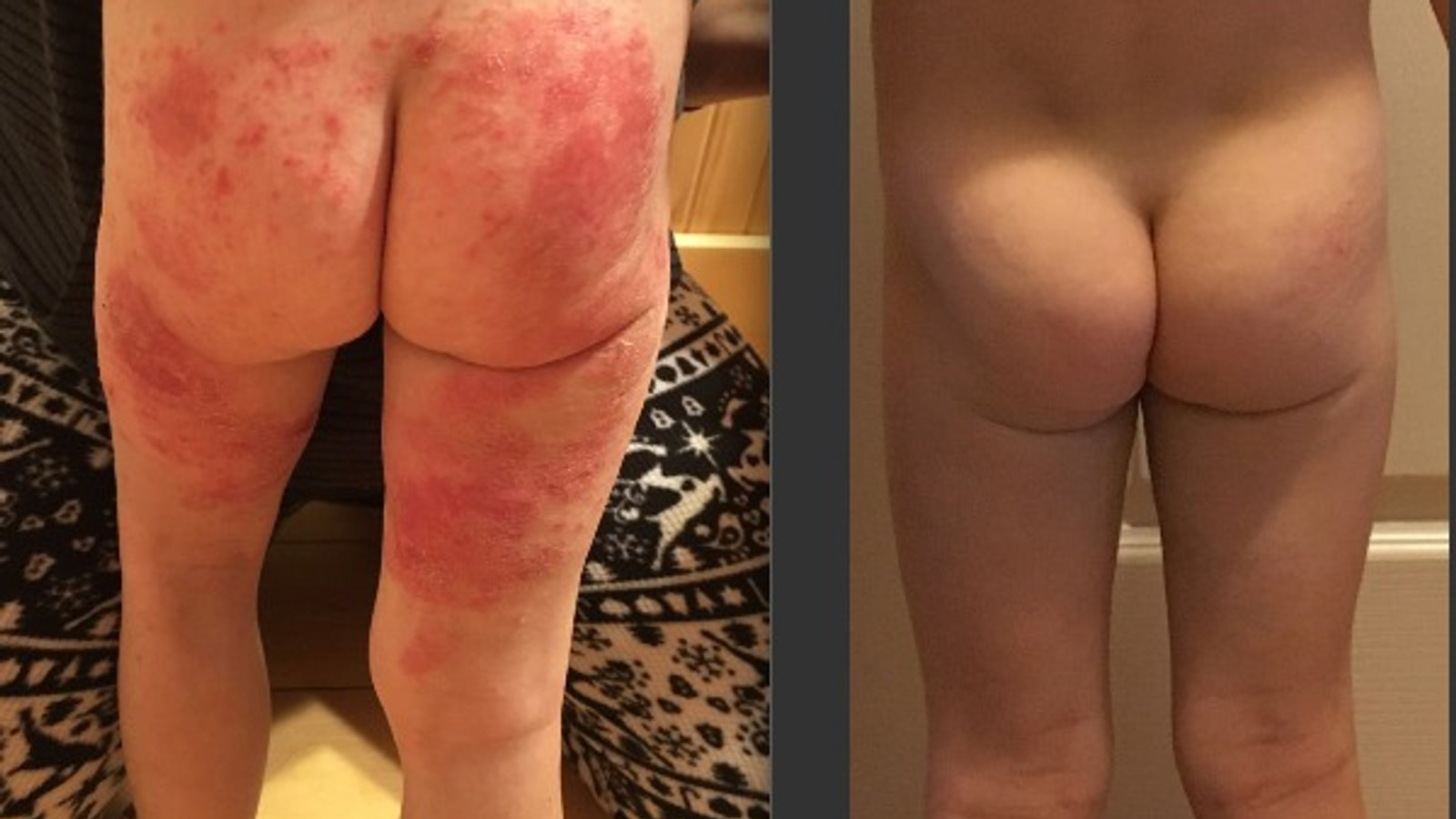 Pediatric atopic dermatitis — dairy elimination case study