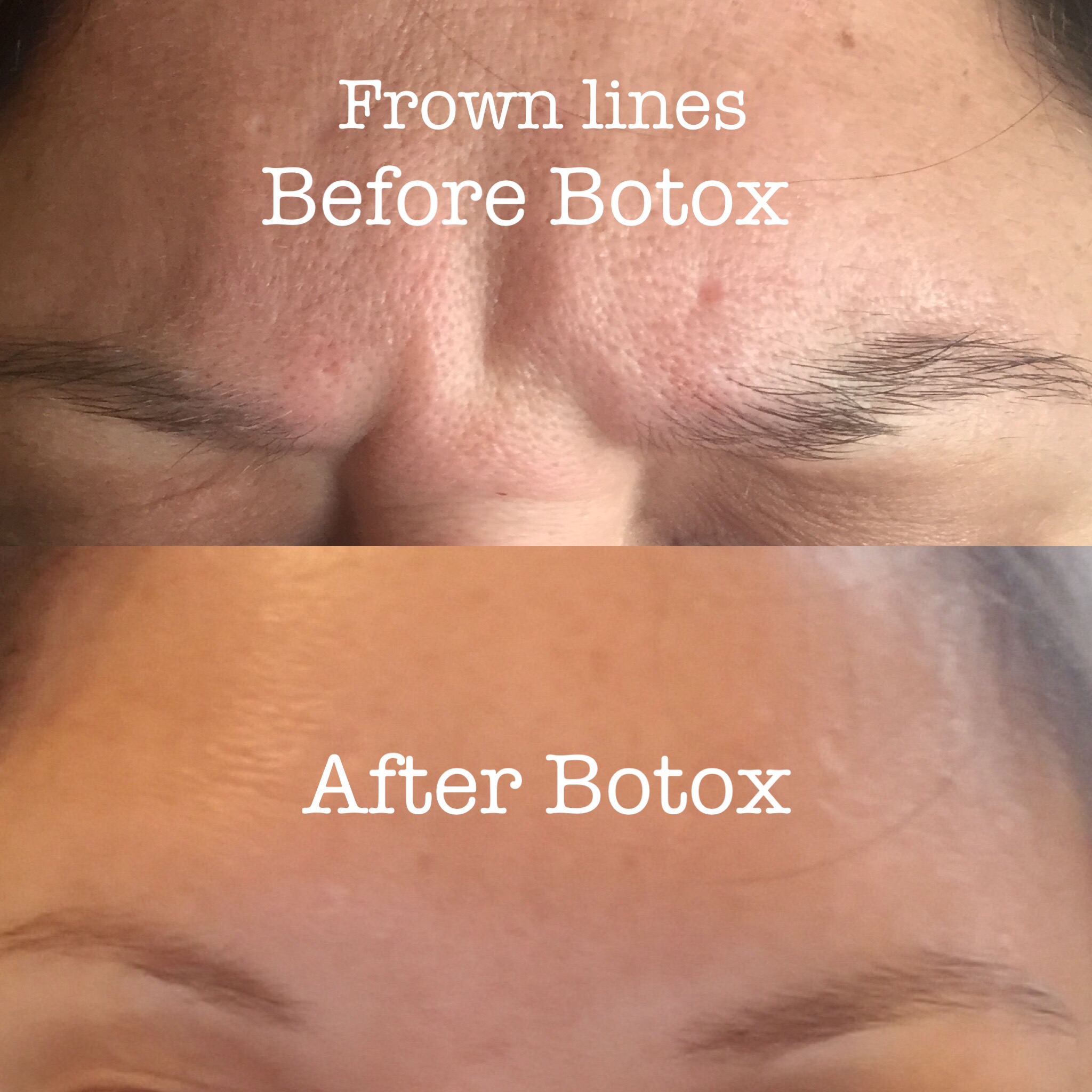 frown lines gone!