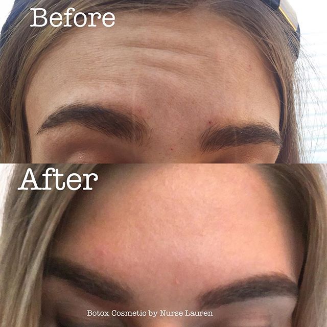 💉Botox cosmetic! Aging prevention is key! Prevent fine lines and wrinkles from setting in with Boto
