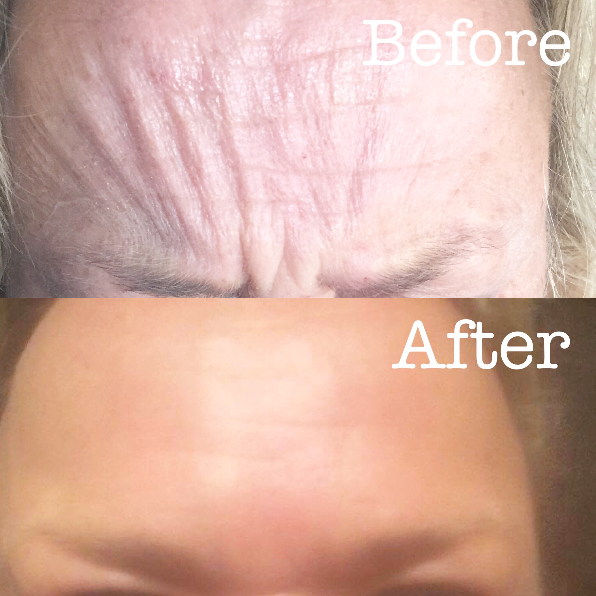 two weeks after botox