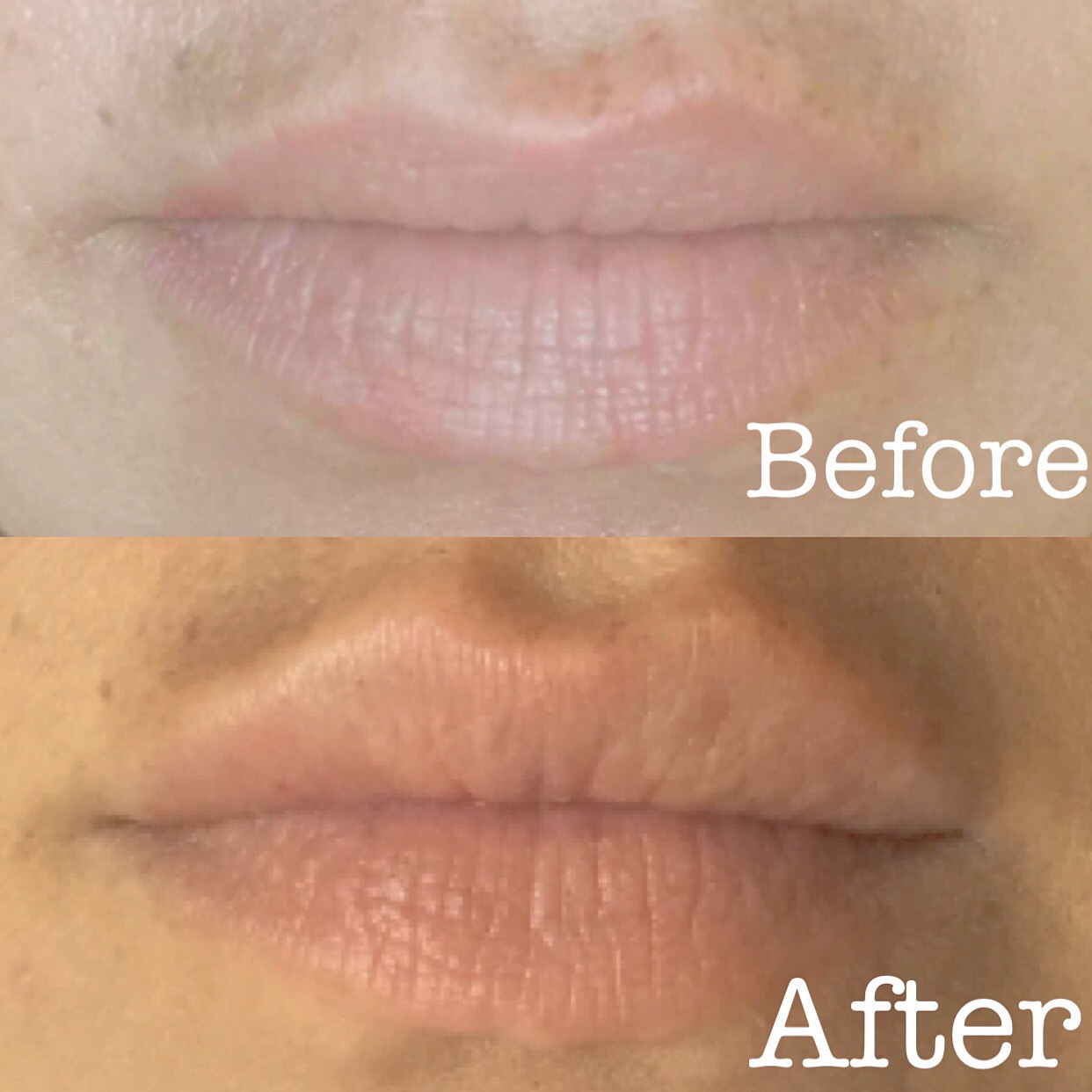Lip injections by Nurse Lauren