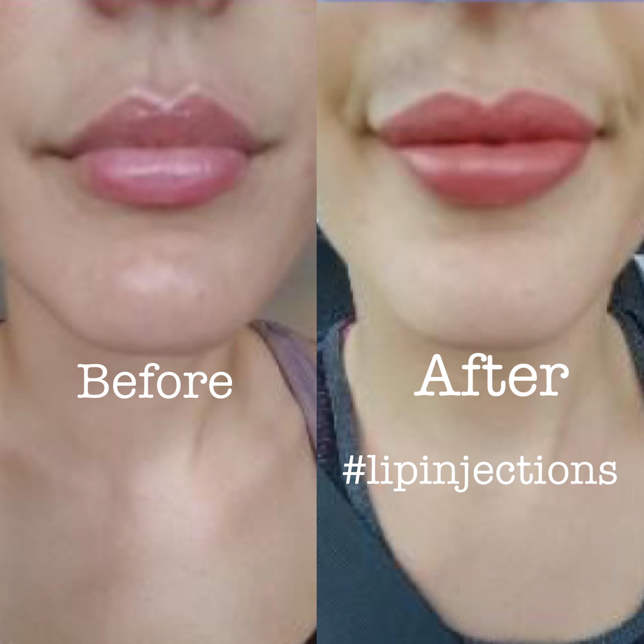 FULLER LIPS!