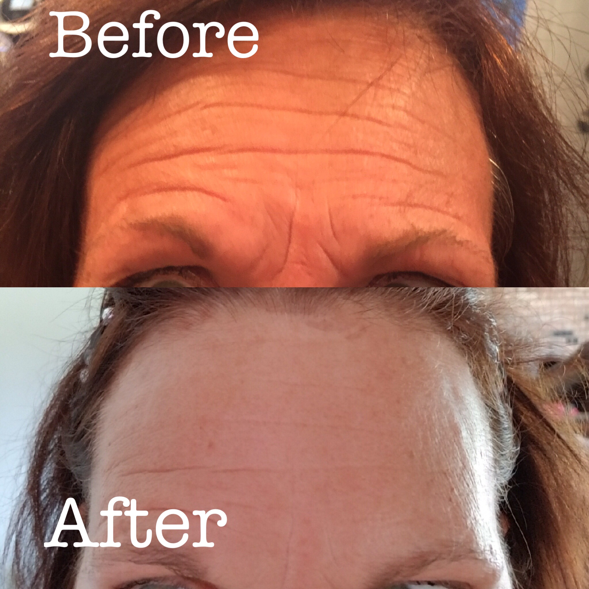 We were able to soften wrinkles